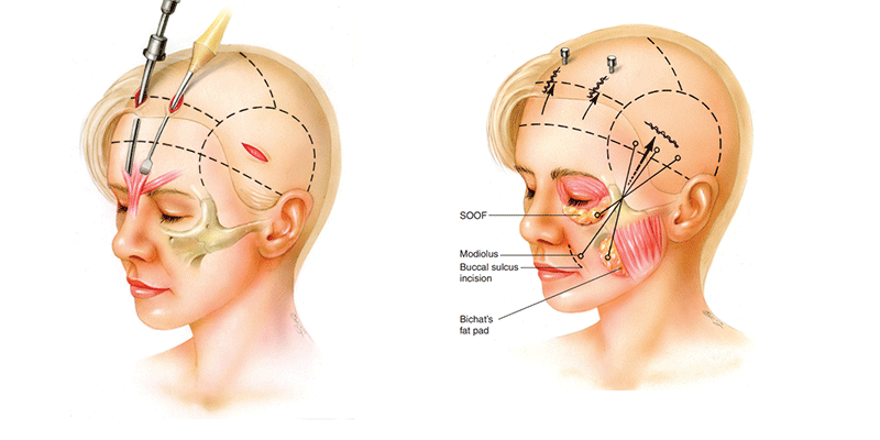 Endoscopic Midfacelifting in Turkey